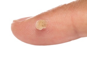 Une verrue est une maladie de peau qui lutte efficacement Skincell Pro