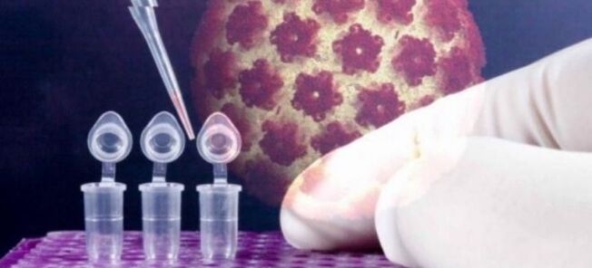 Diagnostic HPV avec le test Digene